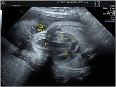 Cantrell Syndrome—A Rare Complex Congenital Anomaly: A Case Report and Literature Review